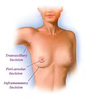 Breast Augmentation incision types - inframammary, peri-areolar, transaxillary