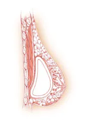 Breast diagram showing subglandular placement