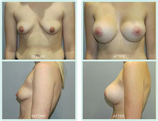 Breast Augmentation before and after set 1