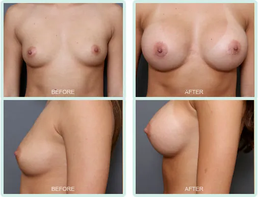 Breast Augmentation before and after set 2