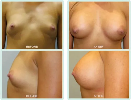 Breast Augmentation before and after set 3