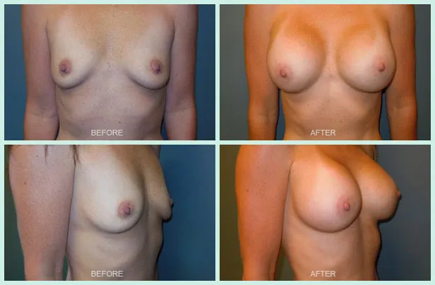 Breast Augmentation before and after set 1