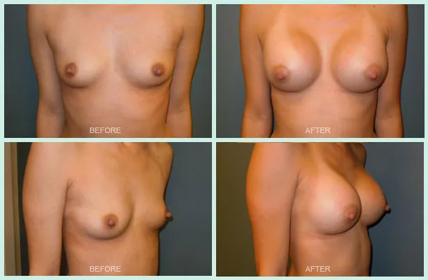 Breast Augmentation before and after set 2