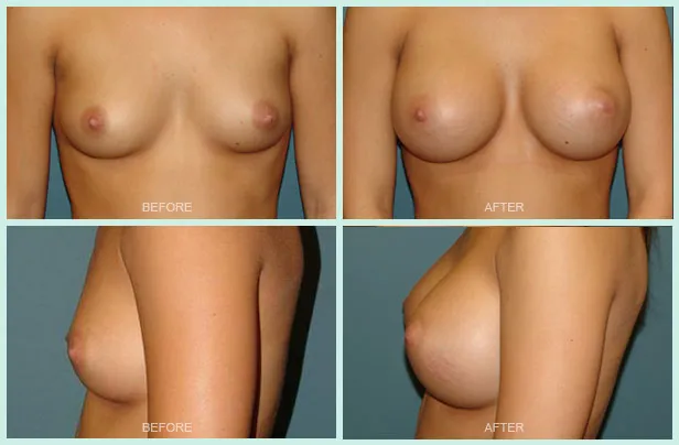 Breast Augmentation before and after set 3