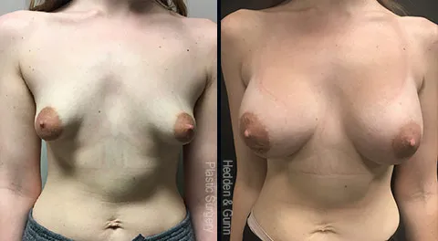 Breast Augmentation before and after Gunn set 1