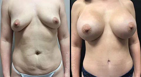 Breast Augmentation before and after Gunn set 2