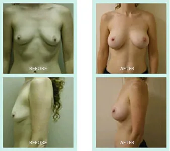 Breast Augmentation before and after set 1