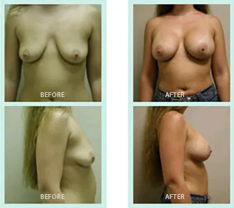 Breast Augmentation before and after set 2