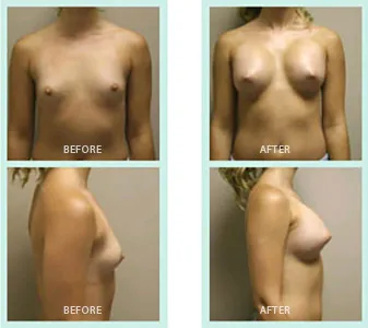 Breast Augmentation before and after set 3