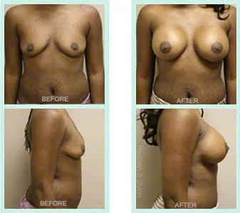 Breast Augmentation before and after set 4