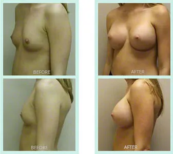 Breast Augmentation before and after set 6