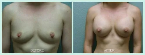 Breast Augmentation before and after set 2