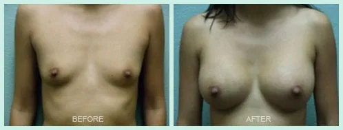 Breast Augmentation before and after set 3