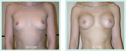 Breast Augmentation before and after set 1
