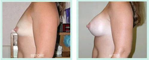 Breast Augmentation before and after set 2