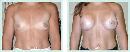 Breast Augmentation before and after set 3